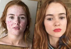 Une Américaine aux prises avec une acné sévère est devenue une véritable star d'Internet: