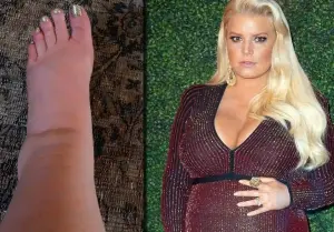 Die schwangere Jessica Simpson entsetzte die Abonnenten mit einem Foto ihres geschwollenen Beins