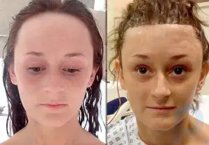 Une Britannique victime d'intimidation pendant des années parce que son front était trop large a dépensé 9 000 $ en chirurgie plastique: