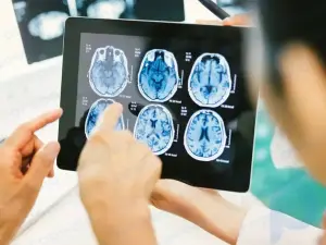 Tumor cerebral: tipos, factores de riesgo, síntomas y tratamiento