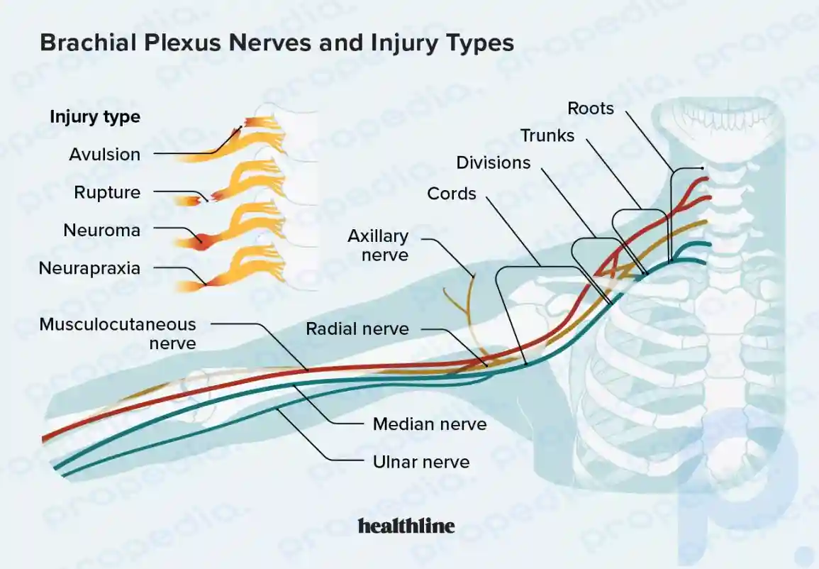 brachial plexus nerves and injury types