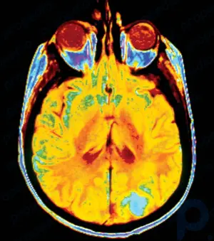 Hirntumor: Pathologie