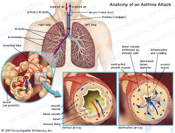 asthma