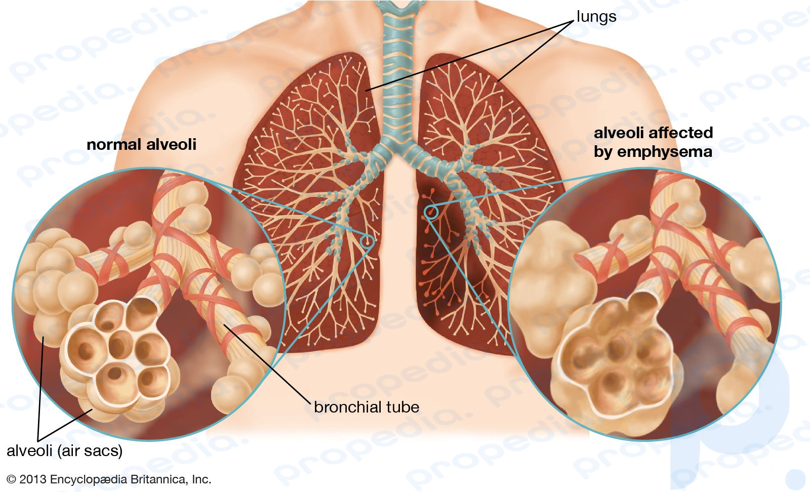 emphysema