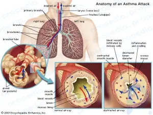 Asthma: pathology