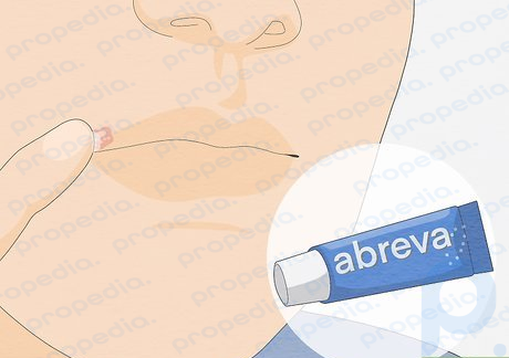 Un ungüento para el herpes labial como el docosanol (Abreva) proporciona alivio directo del dolor.