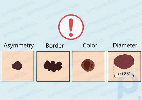 Consultez un dermatologue si vous voyez un gros grain de beauté décoloré ou asymétrique.