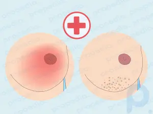 12 Treatments for Itchy Boobs & Nipples