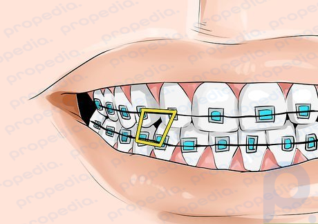 Step 6 Use Front Box Elastics.