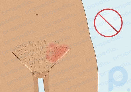 Step 2 Avoid waxing damaged or irritated skin.