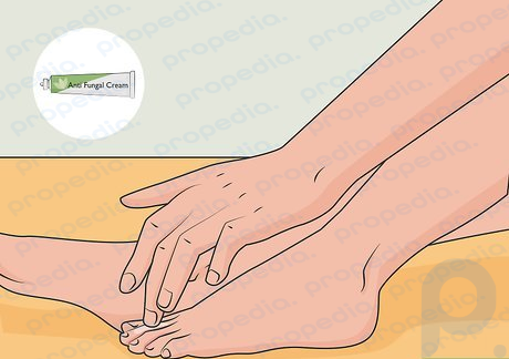 Step 1 Apply an over-the-counter antifungal cream 1-2 times daily.