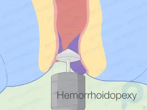 Una guía completa sobre las hemorroides: opciones médicas y en el hogar