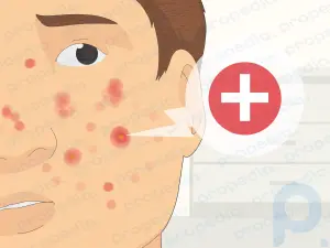 Las mejores formas de deshacerse de las espinillas y reducir el acné rápidamente