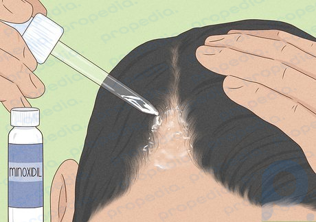 Étape 1 Essayez un médicament topique pour stimuler la croissance des cheveux.