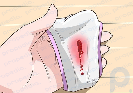 Etapa 7 Procure sangramento de implantação.