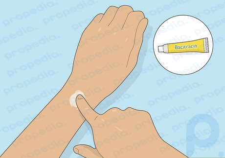 Step 4 Apply an antibiotic cream or ointment.